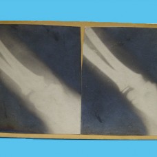 Very Early Real-Photo Xray Stereoview,C1900