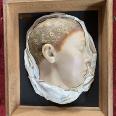 A French dermatological wax model, representing the “favus”.
