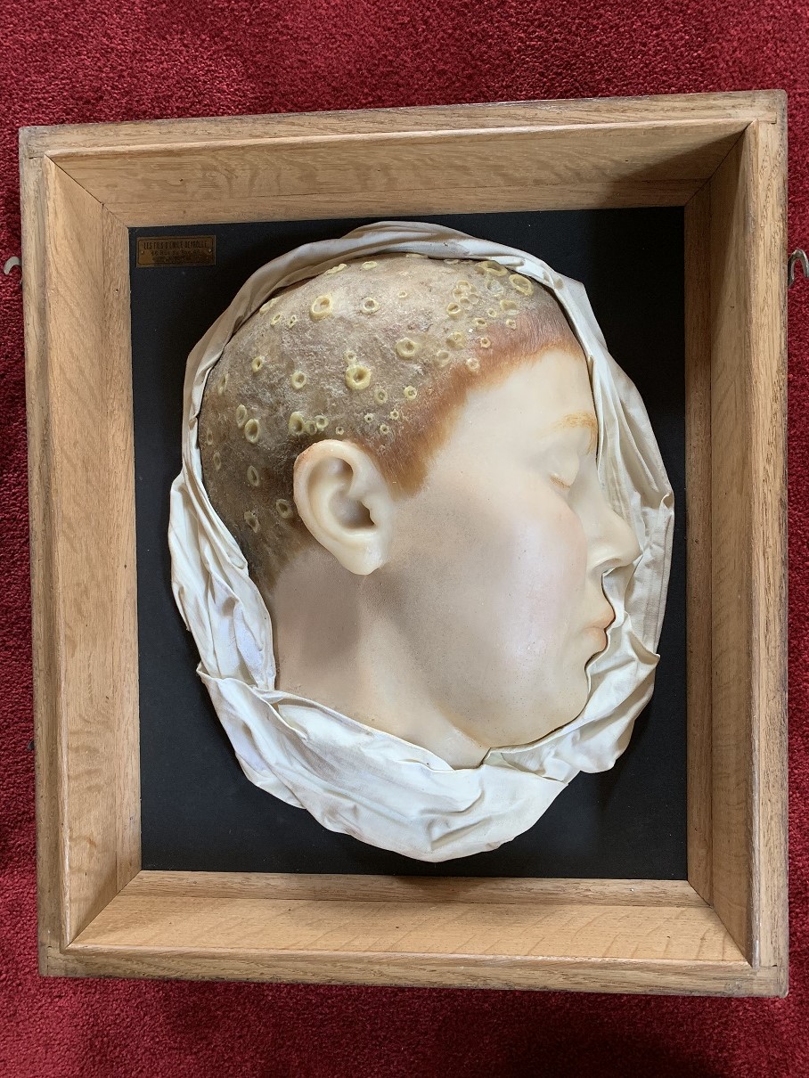 A French dermatological wax model, representing the “favus”.