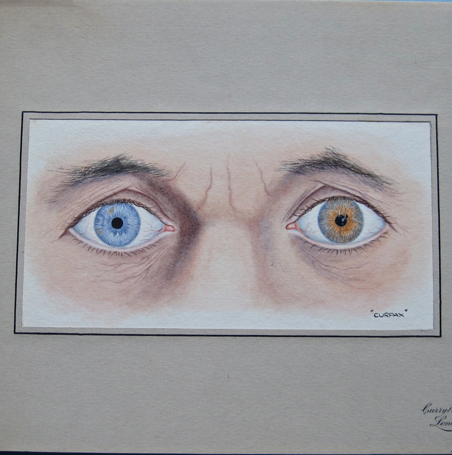 A Collection of Original Watercolor Drawings of Ophthalmic Pathologies