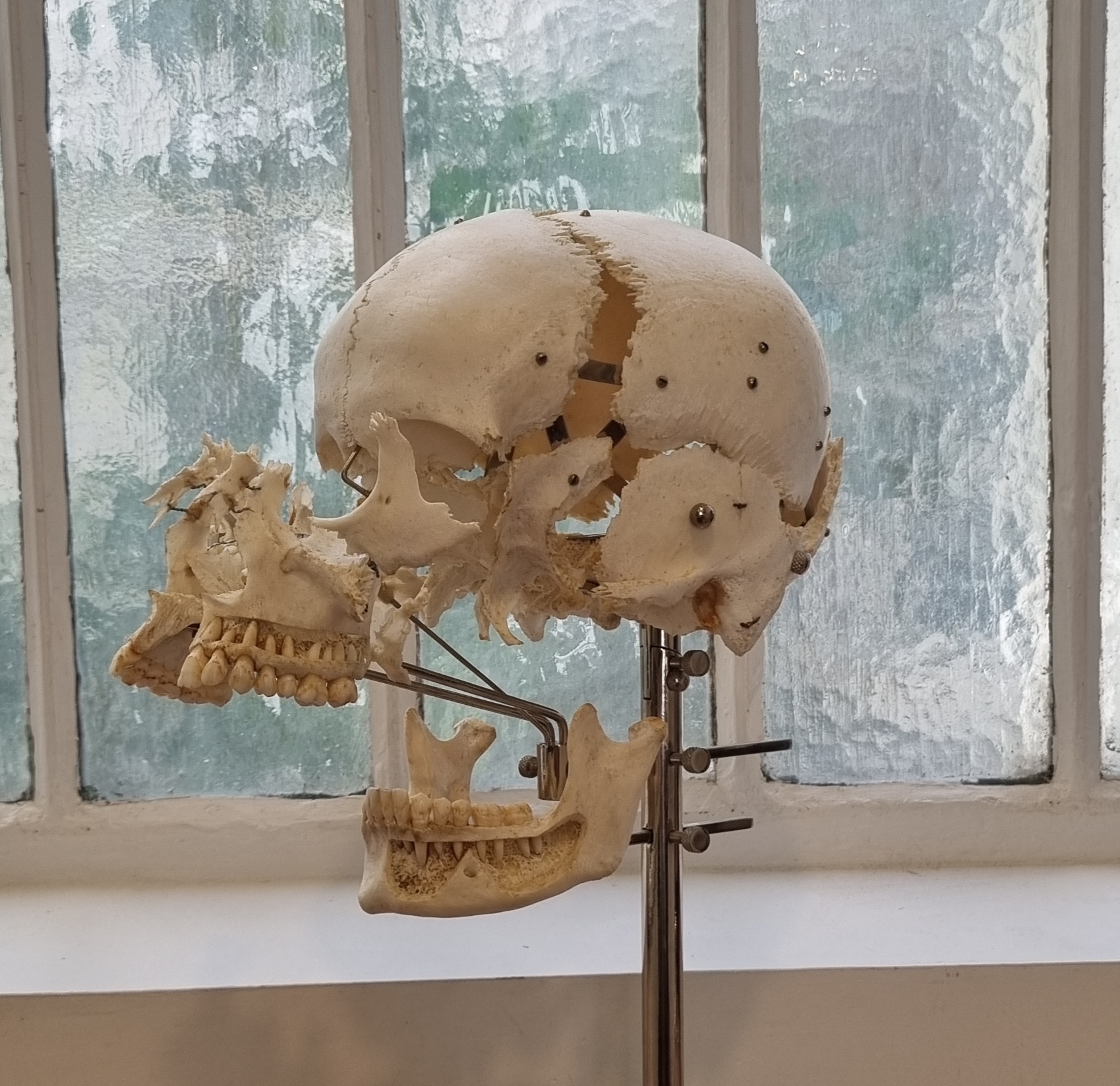 Exploded Skull or Beauchène Skull, France, 20th century