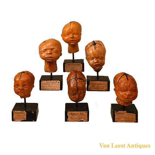Children’s heads with various congenital anomalies, 1920