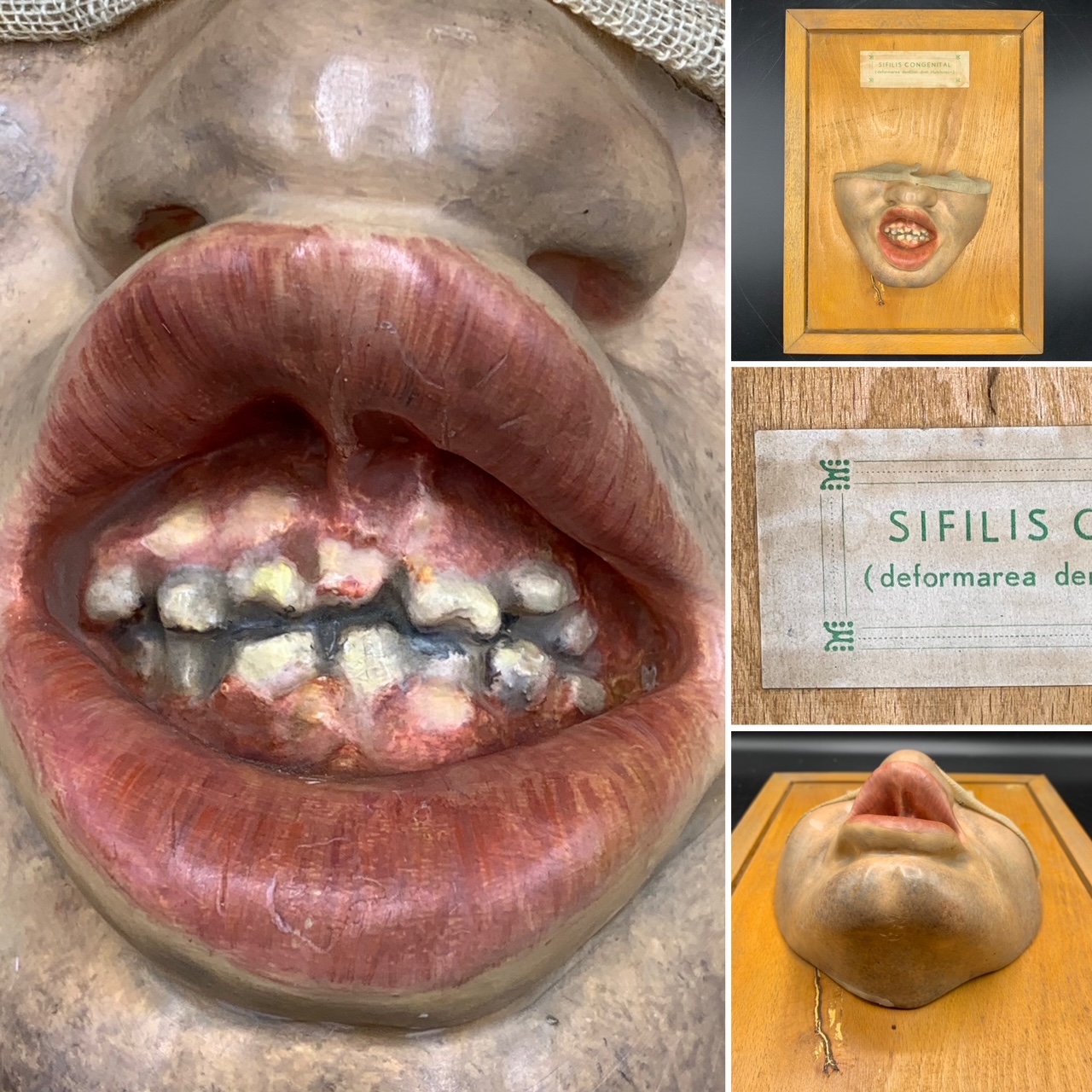 Wax anatomical model of the syphilis effects