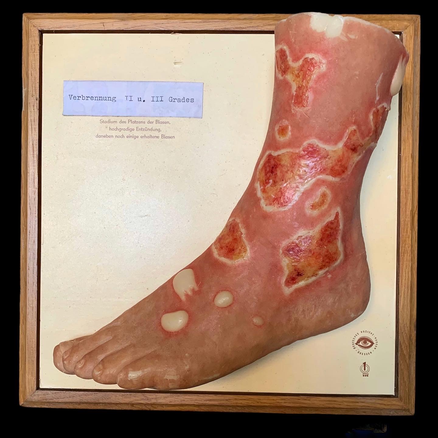 German wax anatomical model of severe burn of the skin of the foot