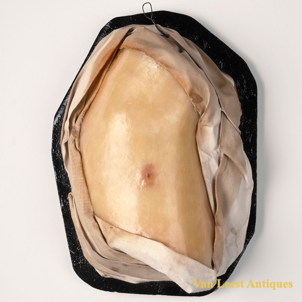 German dermatological wax model of c. 1930